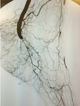 Patients with Chronic Limb-Threatening Ischemia (CLTI) | Society